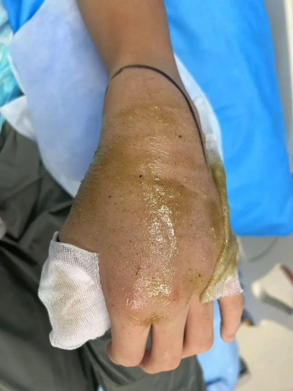 男子徒手抓蛇被咬，惊险四度抢救